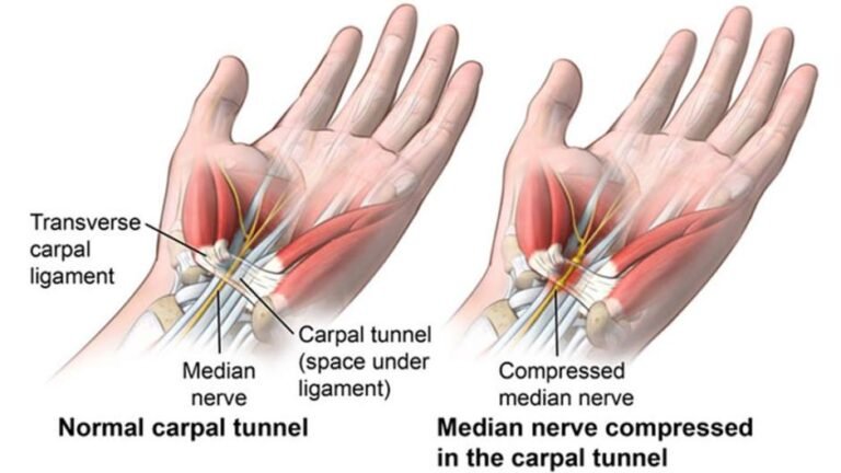 Carpal Tunnel Syndrome | Orchard Health Clinic