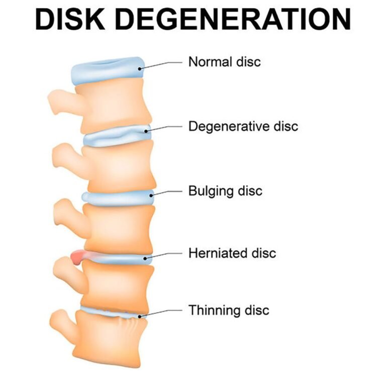 Image of Degenerative Disc Disease | Orchard Health Clinic