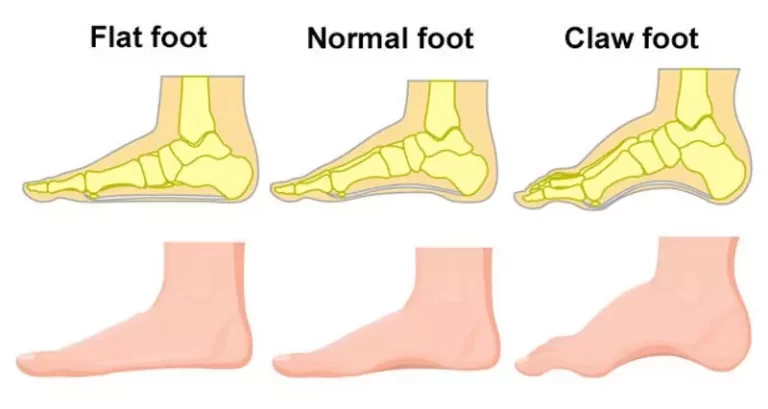 Flat Feet | Orchard Health Clinic