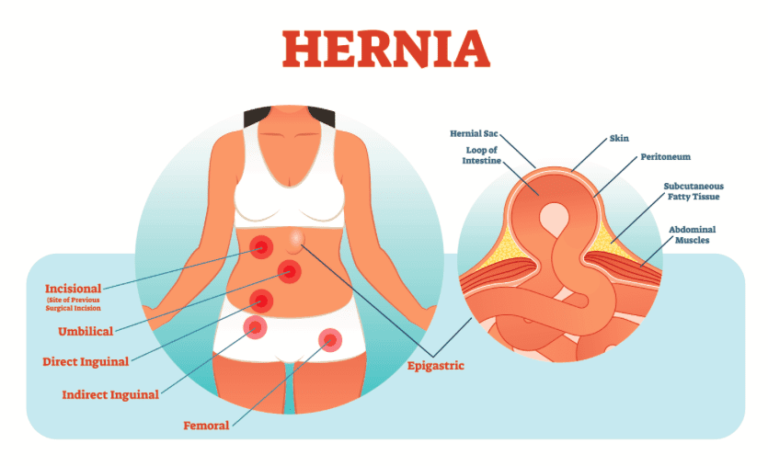 Ilustration of Hernia | Orchard Health Clinic