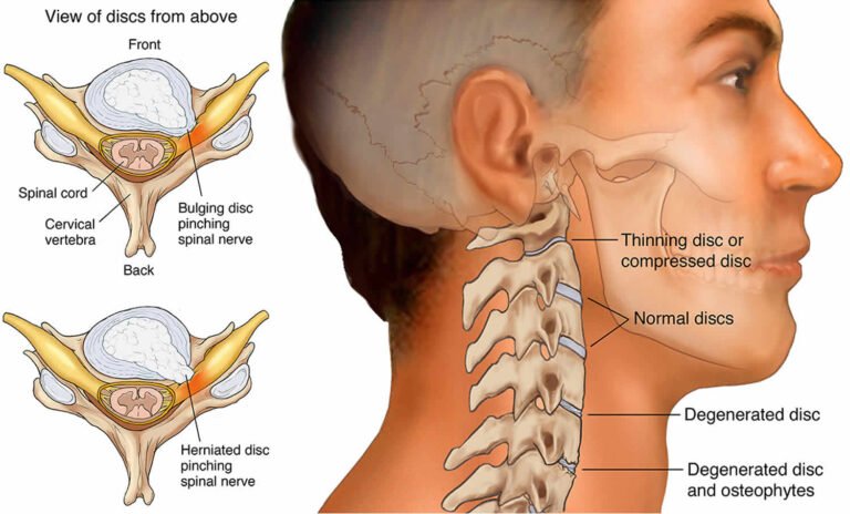 Cervical Radiculopathy | Neck Neurological Dysfunction