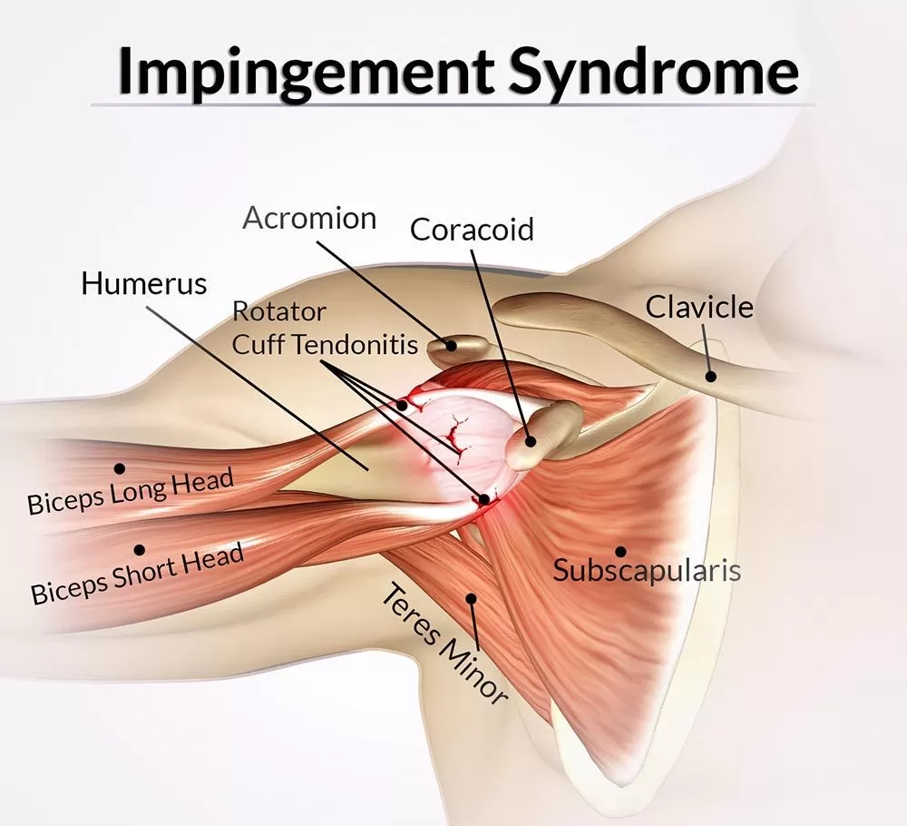 Painful Arc Impingement Syndrome | Orchard Health Clinic