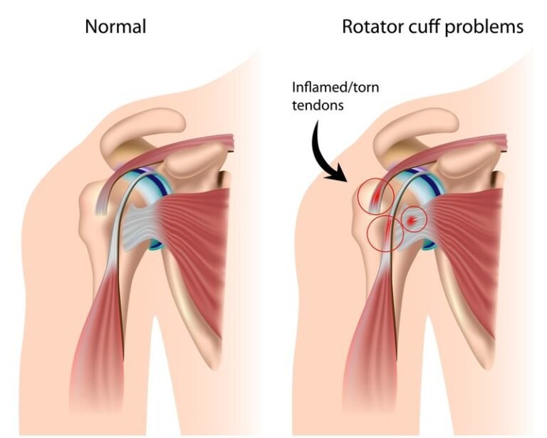 Blood Cell Types | Rotator Cuff Injuries