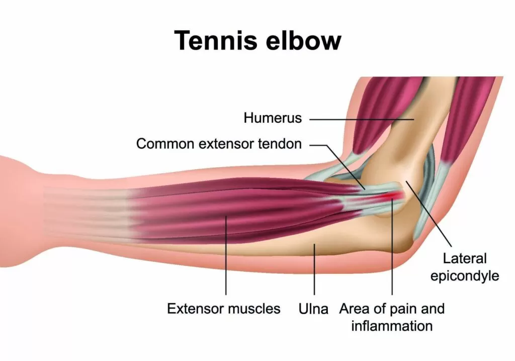 Tennis Elbow Treatment Singapore | Orchard Health Clinic